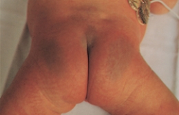 The nurse is assessing a newborn and notes a nevus flammeus birthmark. Which of the following figures depicts this birthmark?  A)     B)     C)     D)   