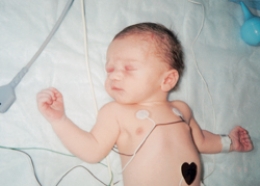 The nurse is assessing a newborn and notes a nevus flammeus birthmark. Which of the following figures depicts this birthmark?  A)     B)     C)     D)   