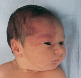 The nurse is assessing a newborn and notes a nevus flammeus birthmark. Which of the following figures depicts this birthmark?  A)     B)     C)     D)   