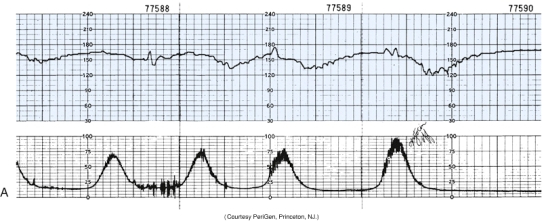 The nurse is monitoring a patient in labor and notes this fetal heart rate pattern on the electronic fetal monitoring strip (see figure) . Which is the most appropriate nursing action?   A)  Administer oxygen with a face mask at 8 to 10 L/minute. B)  Reposition the fetal monitor ultrasound transducer. C)  Assist the patient to the bathroom to empty her bladder. D)  Continue to monitor the patient and fetal heart rate patterns.