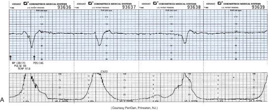 The nurse is monitoring a patient in labor and notes this fetal heart rate pattern on the electronic fetal monitoring strip (see figure) . Which is the most appropriate nursing action at this time?   A)  Decrease the rate of the IV fluids. B)  Document the fetal heart rate pattern. C)  Explain to the patient that the pattern is normal. D)  Perform a vaginal exam to detect a prolapsed cord.