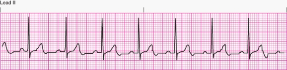 Interpret the following rhythm:   A)  Normal sinus rhythm B)  Sinus bradycardia C)  Sinus tachycardia D)  Sinus arrhythmia