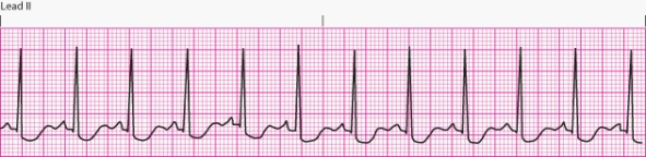 Interpret the following rhythm:   A)  Normal sinus rhythm B)  Sinus bradycardia C)  Sinus tachycardia D)  Sinus arrhythmia