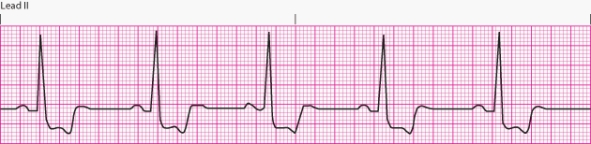 Interpret the following rhythm:   A)  Normal sinus rhythm B)  Sinus bradycardia C)  Sinus tachycardia D)  Sinus arrhythmia