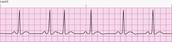 Interpret the following rhythm:   A)  Sinus rhythm with PACs B)  Normal sinus rhythm C)  Sinus tachycardia D)  Sinus bradycardia