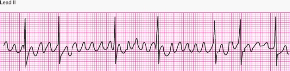 Interpret the following rhythm:   A)  Atrial flutter with variable conduction B)  Ventricular fibrillation C)  Atrial fibrillation D)  Atrial flutter with RVR (rapid ventricular response) 