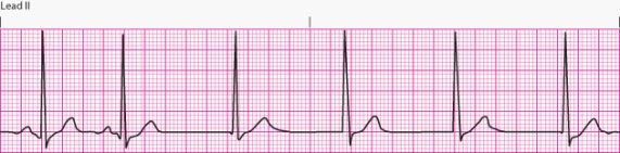 Interpret the following rhythm:   A)  Junctional rhythm B)  An accelerated junctional rhythm C)  A junctional tachycardia D)  Atrial fibrillation