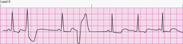 Interpret the following rhythm:   A)  Sinus rhythm with multifocal premature ventricular contractions B)  Sinus rhythm with unifocal premature ventricular contractions C)  Sinus rhythm with bigeminal premature ventricular contractions D)  Sinus rhythm with paired premature ventricular contractions (couplets) 