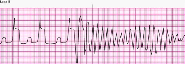 Interpret the following rhythm:   A)  R-on-T phenomenon leading to ventricular fibrillation B)  Sinus rhythm with multifocal premature ventricular contractions C)  Nonsustained ventricular tachycardia D)  Sinus rhythm with bigeminal premature ventricular contractions