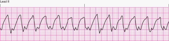 <strong>The patient is alert and talking when the nurse notices the following rhythm.The patient's blood pressure is 90/44 mm Hg.The nurse should </strong> A) defibrillate immediately. B) begin basic life support. C) begin advanced life support. D) treat with intravenous amiodarone or lidocaine.
