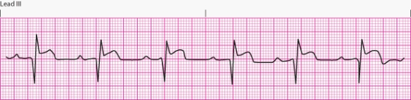 Interpret the following rhythm:   A)  Normal sinus rhythm B)  Sinus rhythm with second-degree AV block C)  Complete heart block D)  Sinus rhythm with first-degree AV block