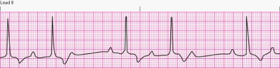 Interpret the following rhythm:   A)  First-degree AV block B)  Second-degree AV block Mobitz I (Wenckebach phenomenon)  C)  Second-degree AV block Mobitz II D)  Third-degree AV block (complete heart block) 