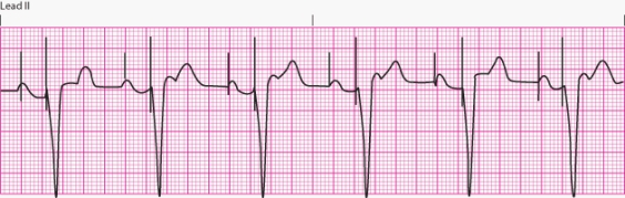 Interpret the following rhythm:   A)  Atrial pacing B)  Ventricular pacing C)  Dual-chamber pacing D)  Transcutaneous pacing