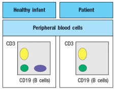 An infant is admitted to the hospital with a history of recurrent and persistent bacterial infections. His physician suspects he has an immunodeficiency disease, and obtains a sample of the patient's peripheral blood. The white blood cells are analyzed by antibody staining followed by flow cytometry, and the results are shown in Figure.     To determine the origin of the peripheral blood cell defect, a bone marrow biopsy is taken from the patient and compared to a healthy control, as shown in Figure.    To obtain additional information, bone marrow cells are treated with a chemical that permeabilizes the cell membrane, allowing antibodies to enter the cells and bind to their target antigens within the cells, a technique known as ‘intracellular staining’. The results of this analysis are shown in Figure .   a) What are populations 1, 2, and 3 in Figure? b) In the analysis of cell surface expression (non-permeabilized bone marrow cells), what are the IgM<sup>lo</sup> Igκ<sup>+</sup>λ<sup>neg</sup> cells as indicated by the arrow in Figure?     c) What is the most likely defect causing the patient's immunodeficiency? The results shown above indicate a specific defect in B cell development. To help identify the defective or missing protein in the patient's developing B cells, bone marrow cells are isolated and protein lysates are prepared for immunoblotting. A series of antibodies are tested and the results are shown in Figure.     d) Given the results from the immunoblotting experiments, what is the most likely candidate molecule (or type of molecule) responsible for the patient's immunodeficiency disease?