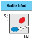  An infant is admitted to the hospital with a history of recurrent and persistent bacterial infections. His physician suspects he has an immunodeficiency disease, and obtains a sample of the patient's peripheral blood. The white blood cells are analyzed by antibody staining followed by flow cytometry, and the results are shown in Figure.     To determine the origin of the peripheral blood cell defect, a bone marrow biopsy is taken from the patient and compared to a healthy control, as shown in Figure.    To obtain additional information, bone marrow cells are treated with a chemical that permeabilizes the cell membrane, allowing antibodies to enter the cells and bind to their target antigens within the cells, a technique known as ‘intracellular staining’. The results of this analysis are shown in Figure .   a) What are populations 1, 2, and 3 in Figure? b) In the analysis of cell surface expression (non-permeabilized bone marrow cells), what are the IgM<sup>lo</sup> Igκ<sup>+</sup>λ<sup>neg</sup> cells as indicated by the arrow in Figure?     c) What is the most likely defect causing the patient's immunodeficiency? The results shown above indicate a specific defect in B cell development. To help identify the defective or missing protein in the patient's developing B cells, bone marrow cells are isolated and protein lysates are prepared for immunoblotting. A series of antibodies are tested and the results are shown in Figure.     d) Given the results from the immunoblotting experiments, what is the most likely candidate molecule (or type of molecule) responsible for the patient's immunodeficiency disease?