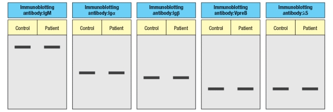  An infant is admitted to the hospital with a history of recurrent and persistent bacterial infections. His physician suspects he has an immunodeficiency disease, and obtains a sample of the patient's peripheral blood. The white blood cells are analyzed by antibody staining followed by flow cytometry, and the results are shown in Figure.     To determine the origin of the peripheral blood cell defect, a bone marrow biopsy is taken from the patient and compared to a healthy control, as shown in Figure.    To obtain additional information, bone marrow cells are treated with a chemical that permeabilizes the cell membrane, allowing antibodies to enter the cells and bind to their target antigens within the cells, a technique known as ‘intracellular staining’. The results of this analysis are shown in Figure .   a) What are populations 1, 2, and 3 in Figure? b) In the analysis of cell surface expression (non-permeabilized bone marrow cells), what are the IgM<sup>lo</sup> Igκ<sup>+</sup>λ<sup>neg</sup> cells as indicated by the arrow in Figure?     c) What is the most likely defect causing the patient's immunodeficiency? The results shown above indicate a specific defect in B cell development. To help identify the defective or missing protein in the patient's developing B cells, bone marrow cells are isolated and protein lysates are prepared for immunoblotting. A series of antibodies are tested and the results are shown in Figure.     d) Given the results from the immunoblotting experiments, what is the most likely candidate molecule (or type of molecule) responsible for the patient's immunodeficiency disease?
