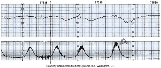 The nurse sees this pattern on the fetal monitor.   What action by the nurse is most appropriate? A)  Apply oxygen via face mask, and position the woman on her left side. B)  Document the findings in the chart along with maternal vital signs. C)  Prepare to start an infusion of oxytocin per unit protocol. D)  Decrease the rate of the woman's IV maintenance fluids.