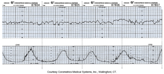 The nurse assesses the fetal monitor and sees the following strip.What action by the nurse is most appropriate?   A)  Administer oxygen by nasal cannula. B)  Reposition the woman. C)  Apply a fetal scalp electrode. D)  Record this reassuring pattern.