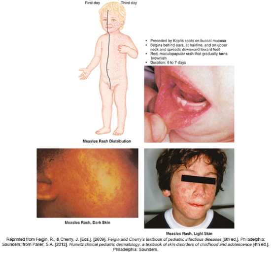 The nurse in the pediatric clinic is caring for a child and assesses this skin rash.What action by the nurse is best?   A)  Inform parents the child will be contagious for one week. B)  Arrange for immediate hospitalization and IV antibiotics. C)  Instruct parents to offer the child a soft, bland diet. D)  Advise parents the child can maintain normal activities.