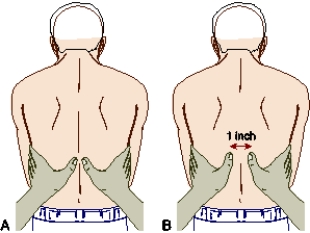 Using the illustrated technique,the nurse is assessing for which finding in a patient with chronic obstructive pulmonary disease (COPD) ?   A) Hyperresonance B) Tripod positioning C) Reduced excursion D) Accessory muscle use