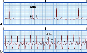 A patient who is complaining of a  racing  heart and feeling  anxious  comes to the emergency department. The nurse places the patient on a heart monitor and obtains the following electrocardiographic (ECG) tracing.   Which action should the nurse take next? A) Prepare to perform electrical cardioversion. B) Have the patient perform the Valsalva maneuver. C) Obtain the patient's vital signs including O2 saturation. D) Prepare to give a b-blocker medication to slow the heart rate.