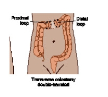 A 33-yr-old male patient with a gunshot wound to the abdomen undergoes surgery,and a colostomy is formed as shown in the accompanying figure. Which information will be included in patient teaching?   A) Stool will be expelled from both stomas. B) This type of colostomy is usually temporary. C) Soft, formed stool can be expected as drainage. D) Irrigations can regulate drainage from the stomas.