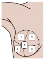 When using the accompanying illustration to teach a patient about breast self-examination,the nurse will include the information that most breast cancers are located in which part of the breast?   A) 1 B) 2 C) 3 D) 4 E) 5