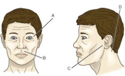 Which is the correct point on the accompanying figure where the nurse will assess for ecchymosis when admitting a patient with a basilar skull fracture?   A) A B) B C) C D) D
