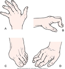 When reviewing the health record for a new patient with rheumatoid arthritis,the nurse reads that the patient has swan neck deformities. Which deformity will the nurse expect to observe when assessing the patient?   A) A B) B C) C D) D
