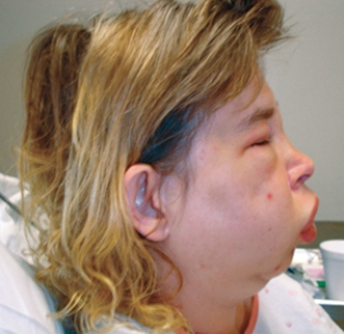 <strong>A client is in the hospital and receiving IV antibiotics.When the nurse answers the client's call light,the client presents an appearance as shown below:   What action by the nurse takes priority?</strong> A) Administer epinephrine 1:1000, 0.3 mg IV push immediately. B) Apply oxygen by facemask at 100% and a pulse oximeter. C) Ensure a patent airway while calling the Rapid Response Team. D) Reassure the client that these manifestations will go away. <div style=padding-top: 35px> 