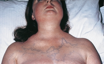 A client in the emergency department reports difficulty breathing.The nurse assesses the client's appearance as depicted below:   What action by the nurse is the priority? A)  Assess blood pressure and pulse. B)  Attach the client to a pulse oximeter. C)  Have the client rate his or her pain. D)  Start high-dose steroid therapy.