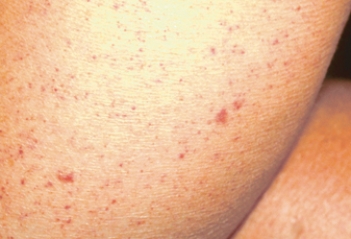 A nurse assesses an older adult client with the skin disorder shown below:   How should the nurse document this finding? A)  Petechiae B)  Ecchymoses C)  Actinic lentigo D)  Senile angiomas