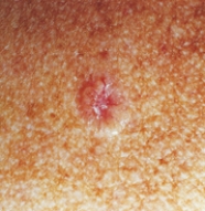 A nurse assesses a client who has a lesion on the skin that is suspicious for skin cancer,as shown below:   Which diagnostic test should the nurse anticipate being ordered for this client? A)  Punch skin biopsy B)  Viral cultures C)  Wood's lamp examination D)  Diascopy