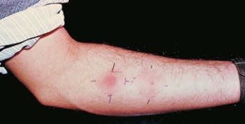 A client is admitted with suspected pneumonia from the emergency department.The client went to the primary care provider a  few days ago  and shows the nurse the results of what the client calls  an allergy test,  as shown below:   What action by the nurse takes priority? A)  Assess the client for possible items to which he or she is allergic. B)  Call the primary care provider's office to request records. C)  Immediately place the client on Airborne Precautions. D)  Prepare to begin administration of intravenous antibiotics.