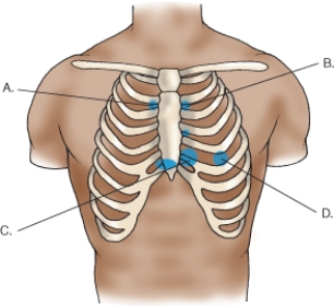 A nurse assesses a client who has aortic regurgitation.In which location in the illustration shown below should the nurse auscultate to best hear a cardiac murmur related to aortic regurgitation?   A)  Location A B)  Location B C)  Location C D)  Location D