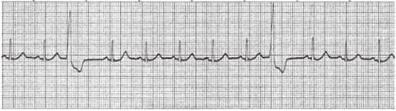 A nurse assesses a client's electrocardiogram (ECG) and observes the reading shown below:   How should the nurse document this client's ECG strip? A)  Ventricular tachycardia B)  Ventricular fibrillation C)  Sinus rhythm with premature atrial contractions (PACs)  D)  Sinus rhythm with premature ventricular contractions (PVCs) 