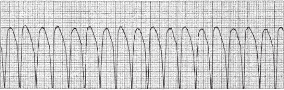 A nurse cares for a client who is on a cardiac monitor.The monitor displayed the rhythm shown below:   Which action should the nurse take first? A)  Assess airway, breathing, and level of consciousness. B)  Administer an amiodarone bolus followed by a drip. C)  Cardiovert the client with a biphasic defibrillator. D)  Begin cardiopulmonary resuscitation (CPR) .