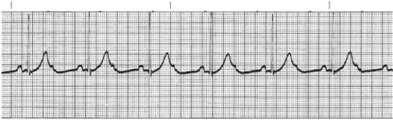 A nurse performs an admission assessment on a 75-year-old client with multiple chronic diseases.The client's blood pressure is 135/75 mm Hg and oxygen saturation is 94% on 2 liters per nasal cannula.The nurse assesses the client's rhythm on the cardiac monitor and observes the reading shown below:   Which action should the nurse take first? A)  Begin external temporary pacing. B)  Assess peripheral pulse strength. C)  Ask the client what medications he or she takes. D)  Administer 1 mg of atropine.
