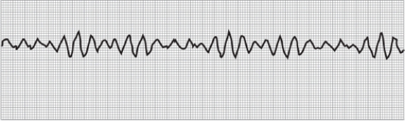The nurse is caring for a client on the medical-surgical unit who suddenly becomes unresponsive and has no pulse.The cardiac monitor shows the rhythm below:   After calling for assistance and a defibrillator,which action should the nurse take next? A)  Perform a pericardial thump. B)  Initiate cardiopulmonary resuscitation (CPR) . C)  Start an 18-gauge intravenous line. D)  Ask the client's family about code status.