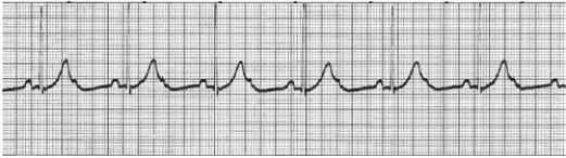 A client had an inferior wall myocardial infarction (MI) .The nurse notes the client's cardiac rhythm as shown below:   What action by the nurse is most important? A)  Assess the client's blood pressure and level of consciousness. B)  Call the health care provider or the Rapid Response Team. C)  Obtain a permit for an emergency temporary pacemaker insertion. D)  Prepare to administer antidysrhythmic medication.