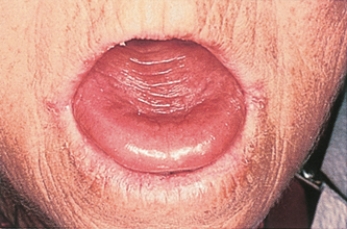 <strong>The nurse assesses a client's oral cavity and makes the discovery shown in the photo below:   What action by the nurse is most appropriate?</strong> A) Encourage the client to have genetic testing. B) Instruct the client on high-fiber foods. C) Place the client in protective precautions. D) Teach the client about cobalamin therapy. <div style=padding-top: 35px> 