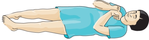 A nurse assesses a client and notes the client's position as indicated in the illustration below:   How should the nurse document this finding? A)  Decorticate posturing B)  Decerebrate posturing C)  Atypical hyperreflexia D)  Spinal cord degeneration