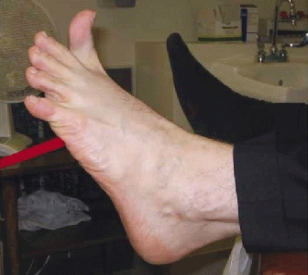 <strong>A nurse assesses the left plantar reflexes of an adult client and notes the response shown in the photograph below:   Which action should the nurse take next?</strong> A) Contact the provider with this abnormal finding. B) Assess bilateral legs for temperature and edema. C) Ask the client about pain in the lower leg and calf. D) Document the finding and continue the assessment. <div style=padding-top: 35px> 