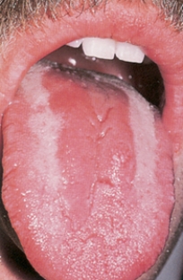 A nurse assesses a client's oral cavity and observes the condition depicted in the photo below:   What action by the nurse is best? A)  Ask about the client's human immunodeficiency virus (HIV)  status. B)  Assess the client for dysphagia. C)  Listen to the client's lung sounds. D)  Refer the client to an oncologist.