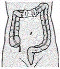 A 33-year-old male patient with a gunshot wound to the abdomen undergoes surgery,and a colostomy is formed as shown in the accompanying figure.Which information will be included in patient teaching?   A)  Stool will be expelled from both stomas. B)  This type of colostomy is usually temporary. C)  Soft, formed stool can be expected as drainage. D)  Irrigations can regulate drainage from the stomas.
