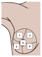 When using the accompanying illustration to teach a patient about breast self-examination,the nurse will include the information that most breast cancers are located in which part of the breast?   A)  1 B)  2 C)  3 D)  4 E)  5