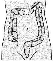 <strong>A patient with a gunshot wound to the abdomen undergoes surgery,and a colostomy is formed as illustrated.What should the nurse explain to the patient?  </strong> A) This type of colostomy is usually temporary. B) Soft,formed stool can be expected as drainage. C) The drainage is liquid at this site but less odorous than at higher sites. D) Colostomy irrigations can help regulate the drainage from the proximal stoma. <div style=padding-top: 35px> 