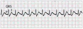 A patient who is complaining of a  racing  heart and nervousness comes to the emergency department.The patient's blood pressure (BP) is 102/68 mm Hg.The nurse places the patient on a cardiac monitor and obtains the following ECG tracing:   Which action should the nurse take next? A)  Have the patient perform the Valsalva manoeuvre. B)  Prepare to administer <font face= symbol >?</font>-blocker medication to slow the heart rate. C)  Get ready to perform electrical cardioversion. D)  Obtain further information about possible causes for the heart rate.