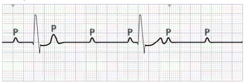 A patient is seen in the emergency department after experiencing dizziness and shortness of breath for several days.During cardiac monitoring in the ED,the nurse notes the following findings: atrial rate 82 beats/min,P-P interval regular;ventricular rate 42 beats/min,R-R interval regular;PR interval variable with no relationship between P and QRS;and QRS complex 0.06 second with normal contour.The following ECG tracing was obtained:   The nurse interprets this cardiac rhythm as which of the following? A)  Third-degree heart block B)  Premature atrial contractions C)  PVCs D)  Paroxysmal supraventricular tachycardia