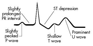 <strong>A patient has the following arterial blood gas results: pH 7.32,PaO<sub>2</sub> 88 mm Hg,PaCO<sub>2</sub> 37 mm Hg,and HCO<sub>3¯</sub> 16 mmol/L.The patient also has the following electrocardiogram (ECG)pattern:   How should the nurse interpret these results?</strong> A) Respiratory acidosis with hyperkalemia B) Respiratory alkalosis with hyperkalemia C) Metabolic acidosis with hypokalemia D) Metabolic alkalosis with hypokalemia <div style=padding-top: 35px> 